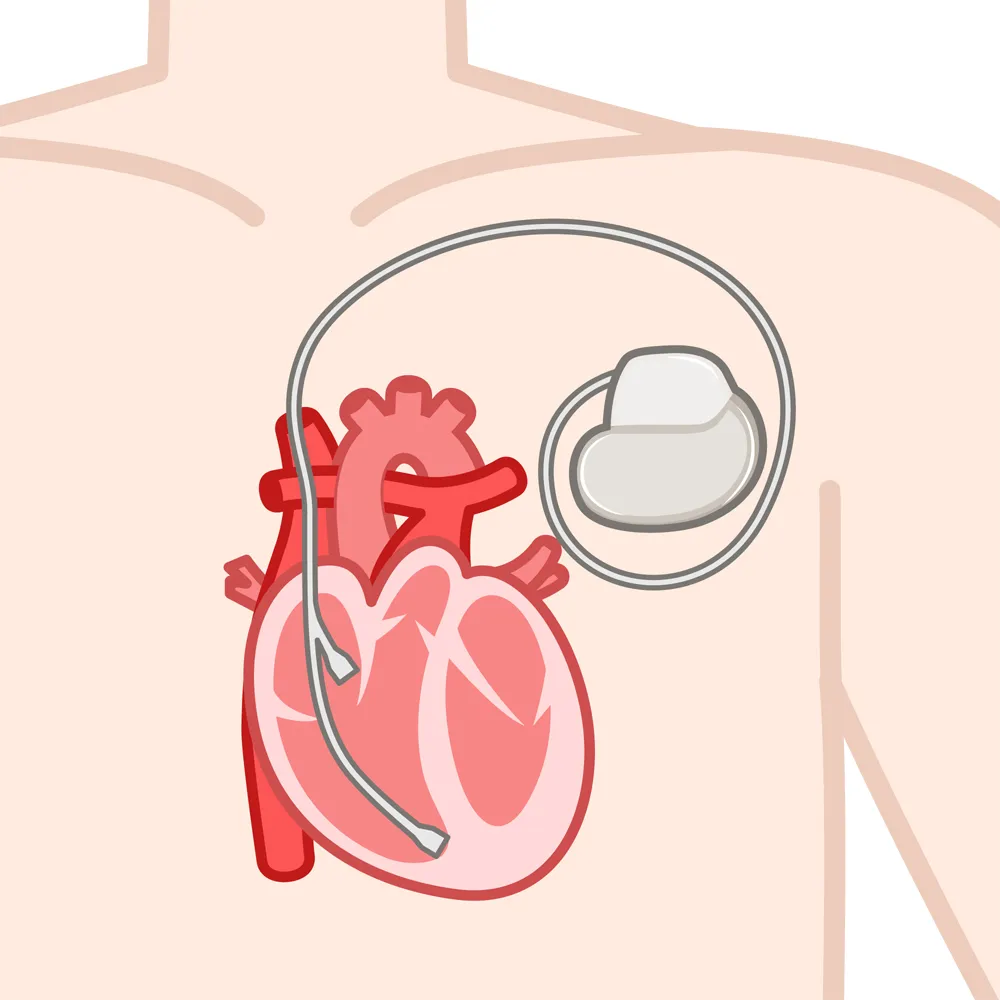 ペースメーカーを入れている場合でも火葬は問題なく行えるのでしょうか